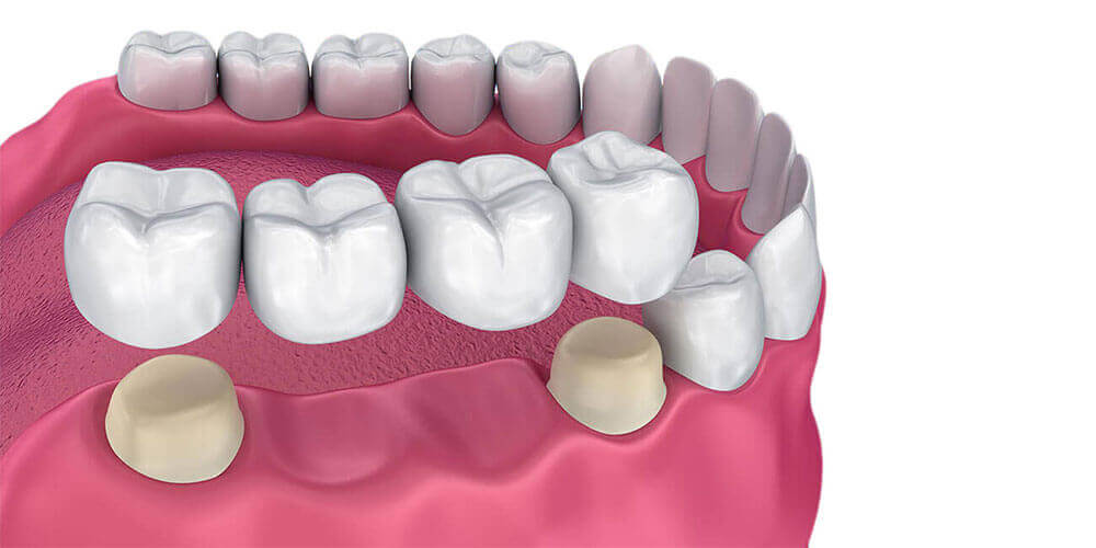 Dental Bridges Thamesford
