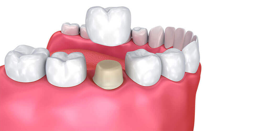 Dental Crowns Thamesford