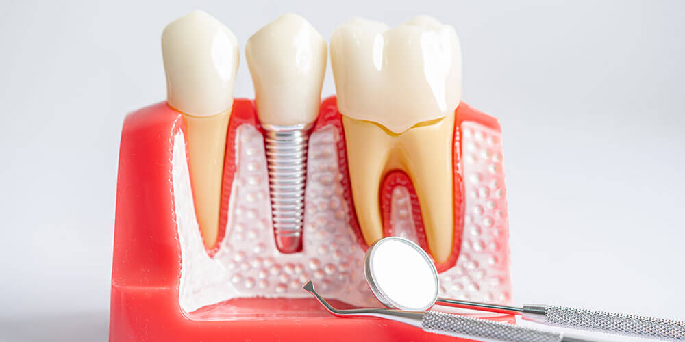 Dental Implants Thamesford