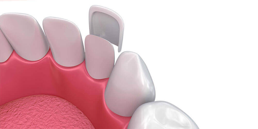 Dental Veneers Thamesford